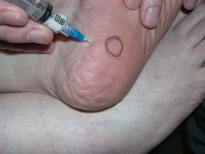 Injection Therapy